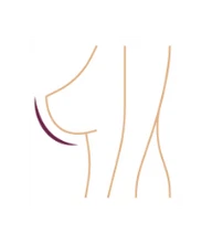 breast_1 Operace prsou